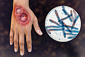 Buruli ulcer and Mycobacterium ulcerans, illustration