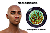 Nasal rhinosporidiosis, illustration