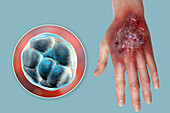 Protothecosis infection on a human hand, illustration