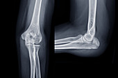 Fractured ulna, X-rays