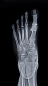 Healthy foot, X-ray