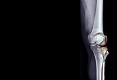 Healthy knee joint, MRI scan and X-ray