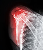 Fractured shoulder, X-ray