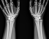 Healthy wrists, X-ray