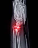 Fractured ulna, X-ray