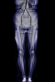 Healthy torso and lower body, X-ray