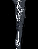 Femoral artery, CT scan