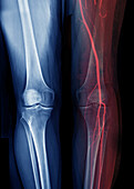 Legs, X-rays