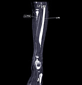 Femoral artery, CT scan