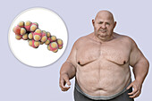 Obesity and dyslipidaemia, conceptual illustration