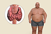 Thyroid diseases and obesity, conceptual illustration