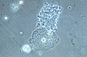 Bacterial vaginosis, light micrograph