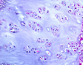 Chondrosarcoma, light micrograph