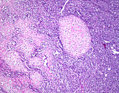 Mesenchymal chondrosarcoma, light micrograph