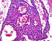Telangiectatic osteosarcoma, light micrograph