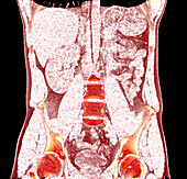 Missing kidney, CT scan