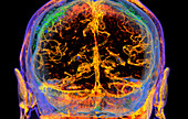 Cerebral arteries, CT scan