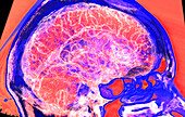 Cerebral arteries, CT scan