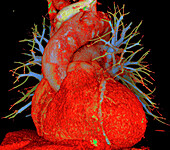 Atherosclerosis, CT scan