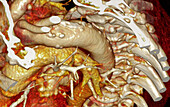 Atherosclerosis, CT scan