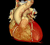 Atherosclerosis, CT scan