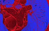 Healthy heart and lungs, CT scan