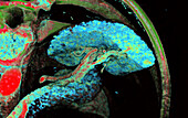 Healthy pancreas and spleen, CT scan