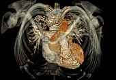 Healthy heart, CT scan