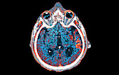 Sturge-Weber syndrome, CT scan