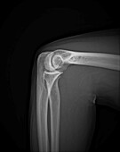 Healthy elbow joint, X-ray