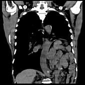 Hiatus hernia, CT scan