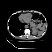 Hiatus hernia, CT scan