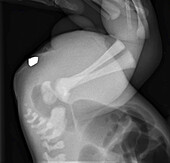 Invertogram X-ray