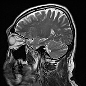 Healthy human brain, MRI scan