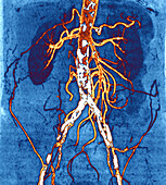 Atherosclerosis, CT scan