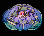 Atherosclerosis, CT scan