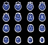 Parkinson's disease electrode implants, CT scans