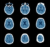 Parkinson's disease electrode implants, CT scans