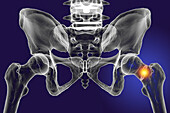 Fracture of the femur neck, illustration