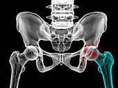 Legg-Calve-Perthes disease, illustration