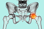 Legg-Calve-Perthes disease, illustration