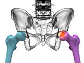 Legg-Calve-Perthes disease, illustration