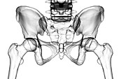 Legg-Calve-Perthes disease, illustration