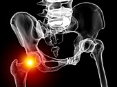 Hip joint pain, conceptual illustration