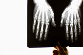 Hand einer medizinischen Fachkraft, die ein Röntgenbild von zwei Händen hält