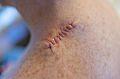 Medizinische Fäden im Rücken einer Frau nach einer Operation