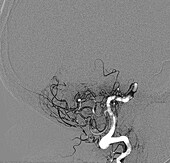 Ischaemic stroke, CT scan