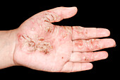 Infected eczema