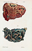 Lungs infected with tuberculosis, 19th century illustration