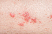 Lichen planus